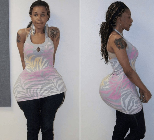 WTF?!? Woman Hospitalized Due to Cement Butt Injections!!
