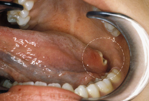 Advisory: Can Oral Sex Cause Throat Cancer?